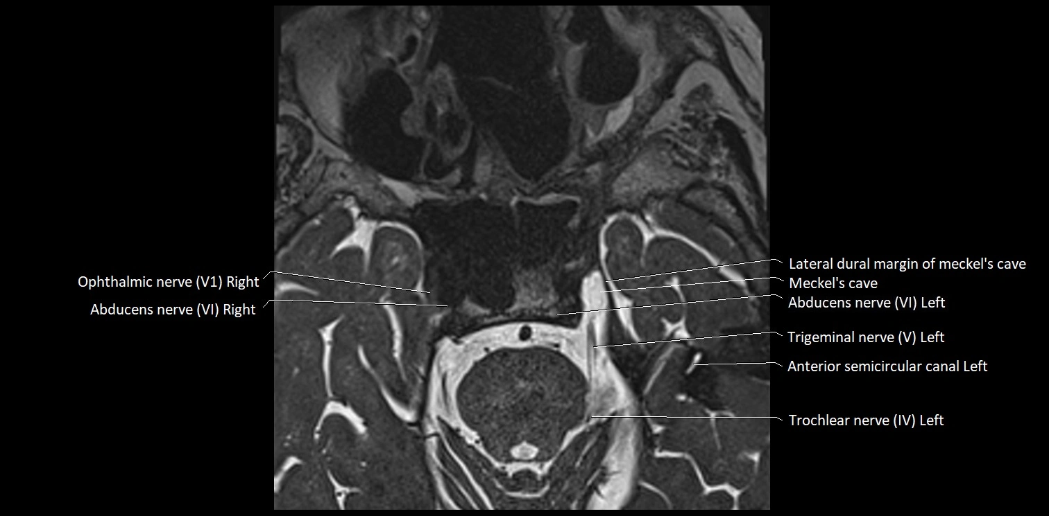 Cranial nerve anatomy axial MRI 3T image 38.webp